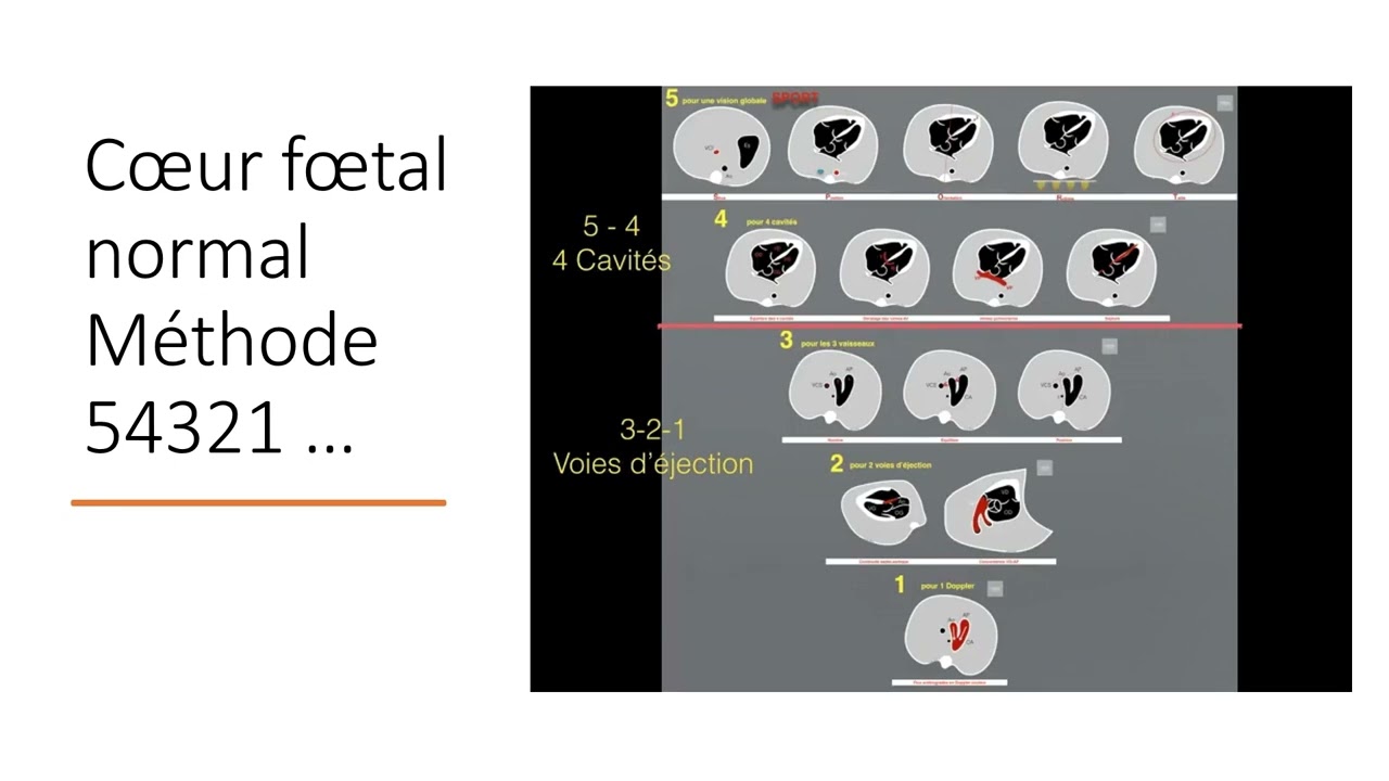 Les journées d'échographie: Imagerie de la femme et du Fœtus:  Gargouri rania : cœur fœtal (1)