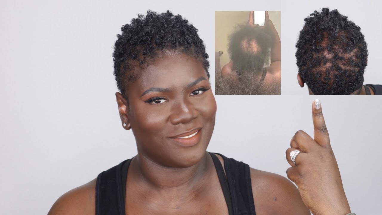 How to regrow your hair with CCCA or scarring alopecia