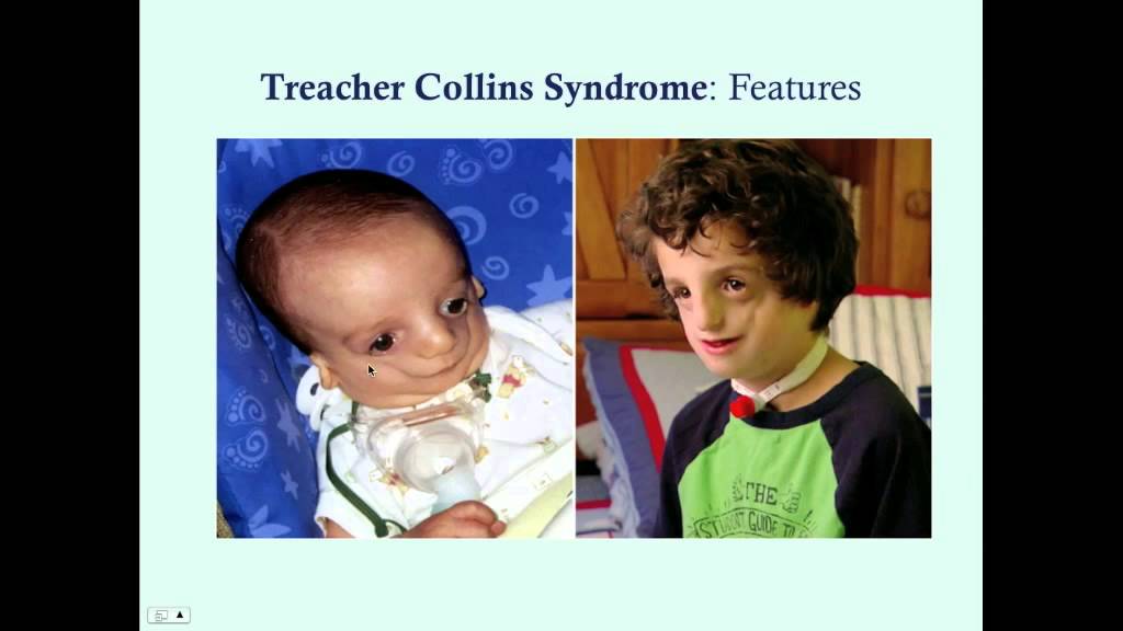 Treacher Collins Syndrome - CRASH! Medical Review Series