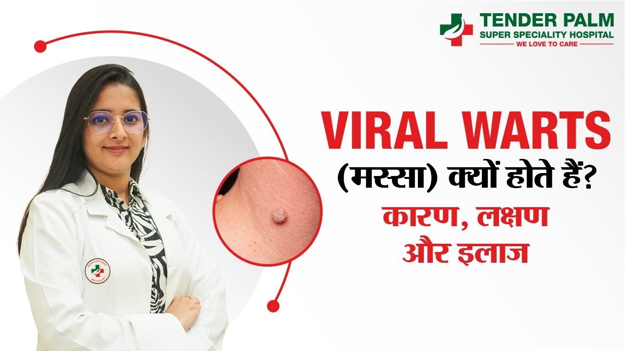 Viral Warts (Massay) Kya Hote Hain? Symptoms, Causes & Treatments Explained by Dermatologist