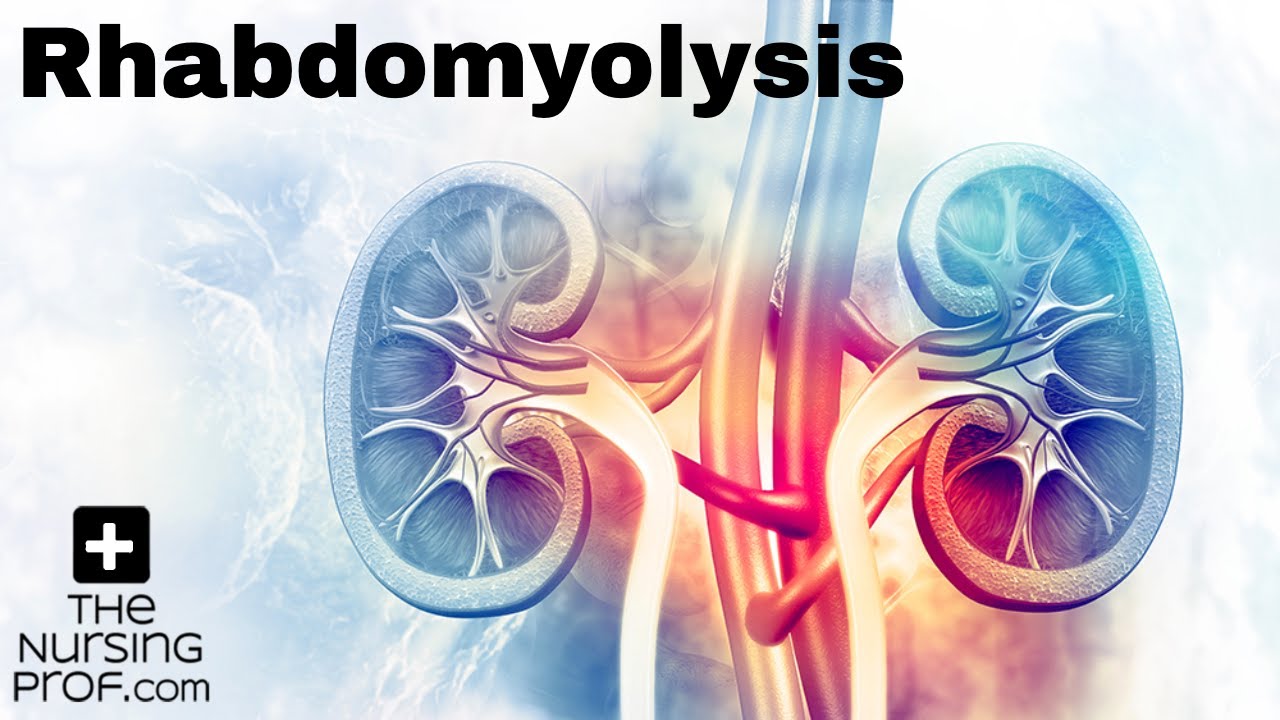 Rhabdomyolysis: What You Need to Know