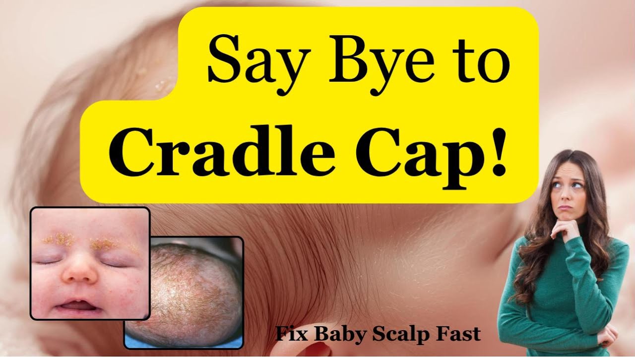 Cradle Cap in Babies: Causes, Treatment & Home Care Tips | Health Visitor Advice (UK)  #parenting