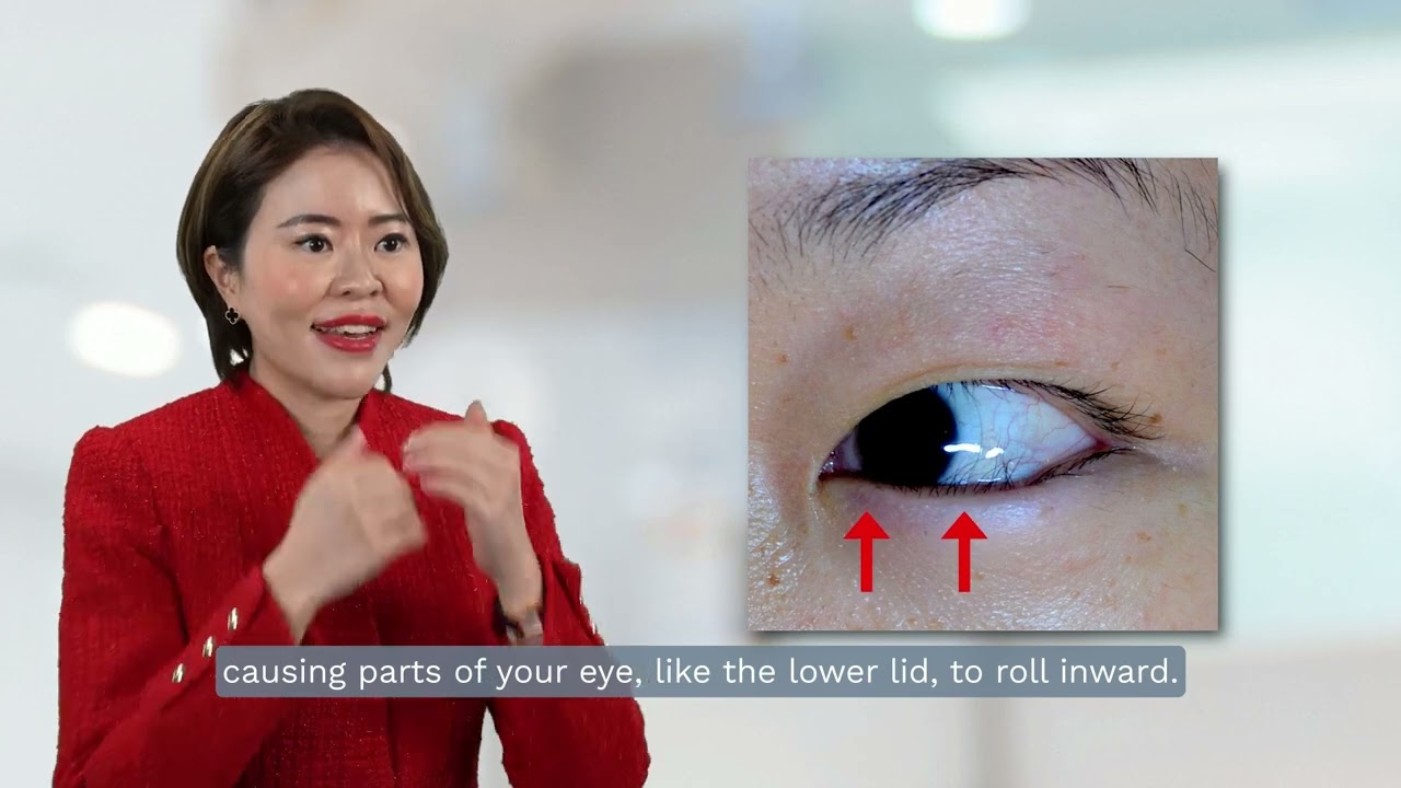 3 Signs You Might Need Eyelid Surgery (and Not Even Know It)
