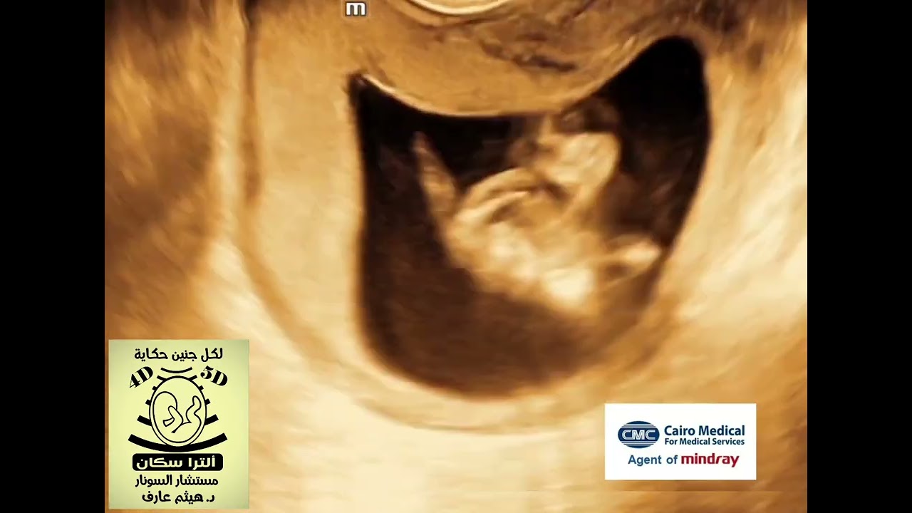 Axillary lymphangioma fetal ultrasound  Follow the hashtag 
