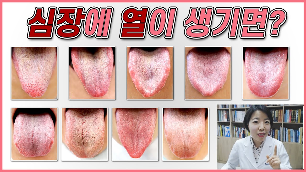 심장에 열이 생기면 나타나는 증상과 혀의 모습은?