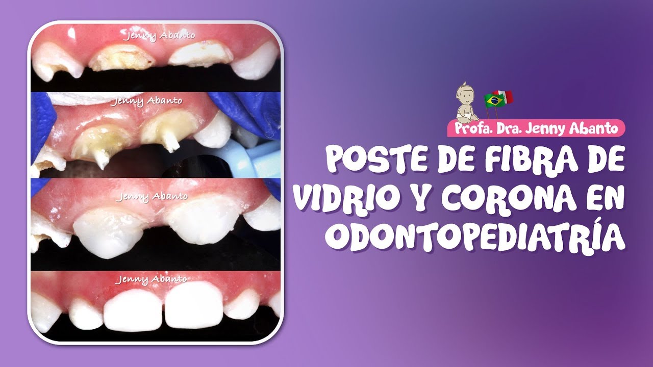 POSTE DE FIBRA DE VIDRIO Y CORONA EN ODONTOPEDIATRÍA