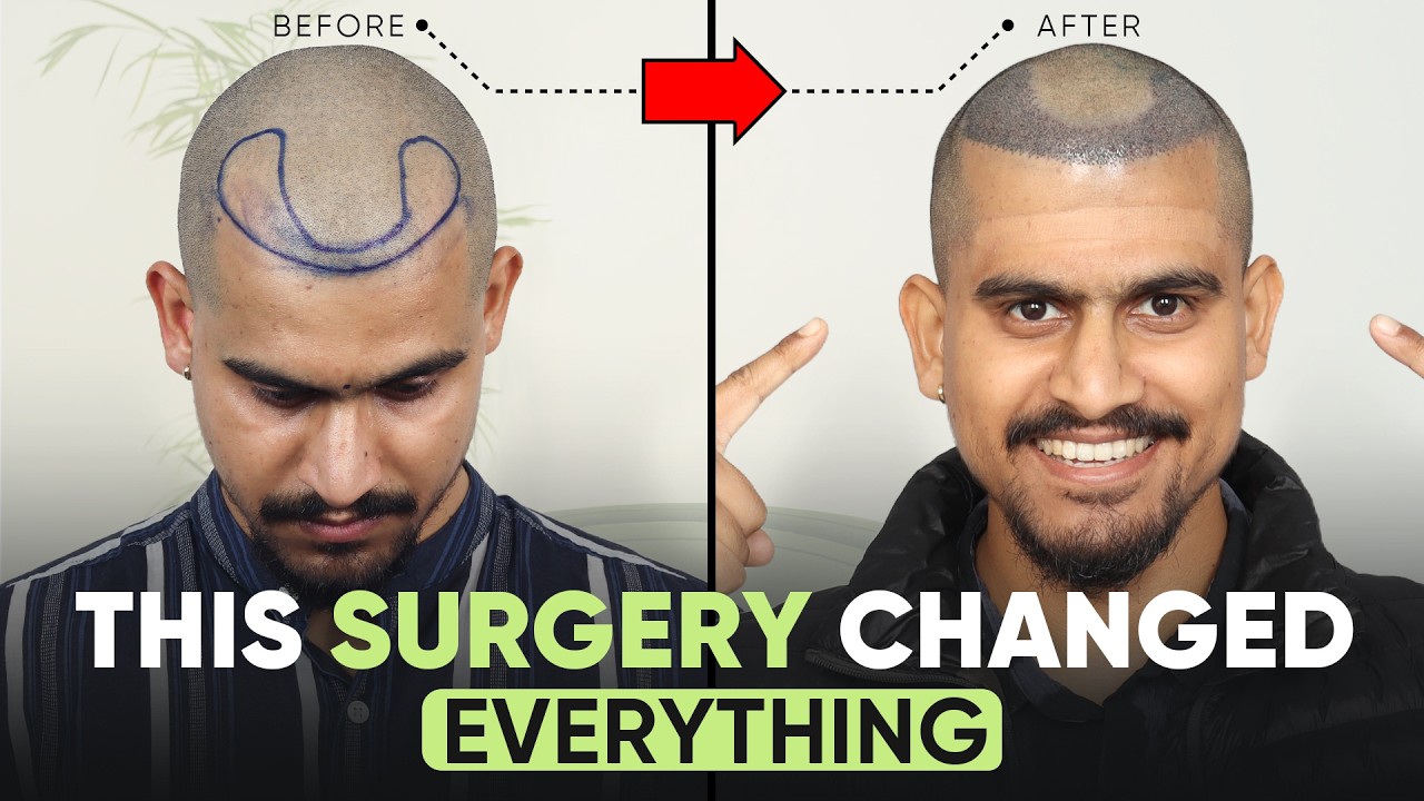 Hair Transplant in Ahmedabad (HX-AQGV) | Best Results & Cost of Hair Transplant in Ahmedabad