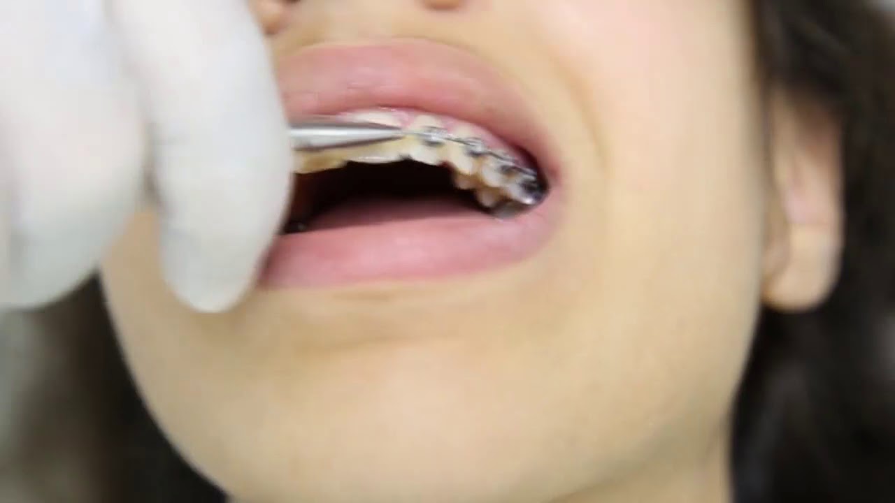 Ligature En Huit par DR. EL HAD, Clinique dentaire Casa City Smile