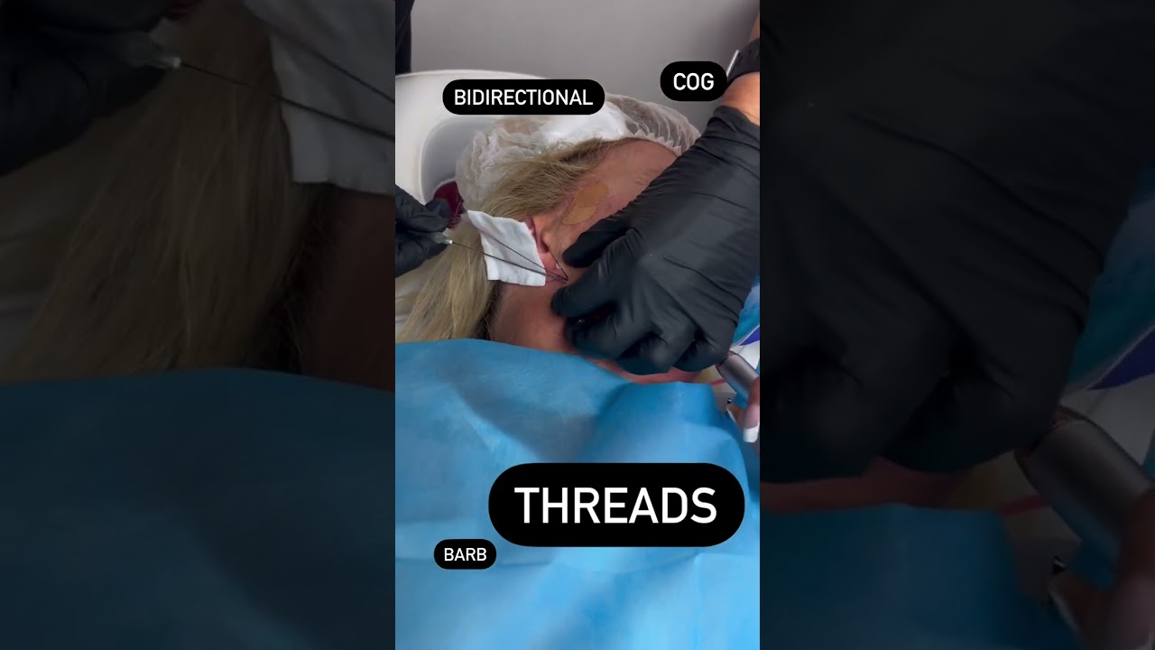 PDO threads lift. Learn which one are the best for you. Call 📞 954-456-4777. #shorts