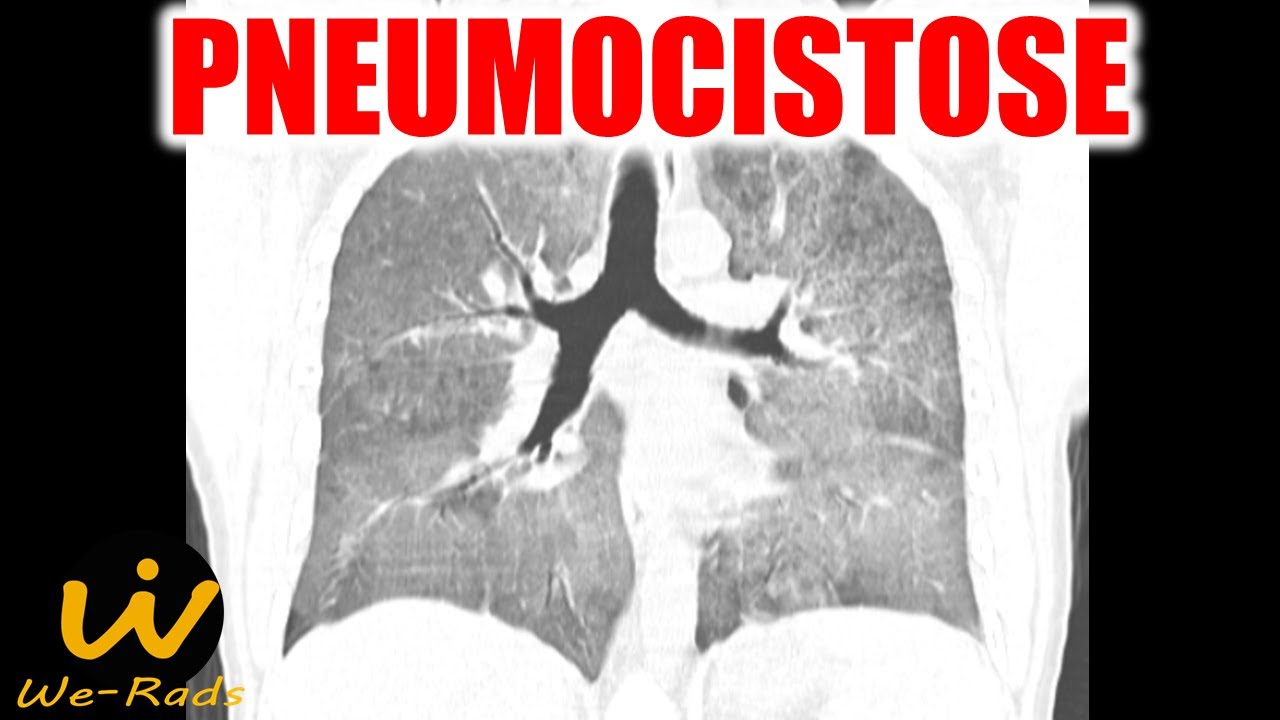 Pneumocistose em HIV / AIDS na Tomografia Computadorizada de Tórax