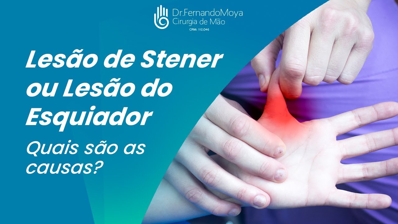 Lesão de Stener ou Lesão do Esquiador. Quais são as causas? | Dr. Fernando Moya CRM 112046