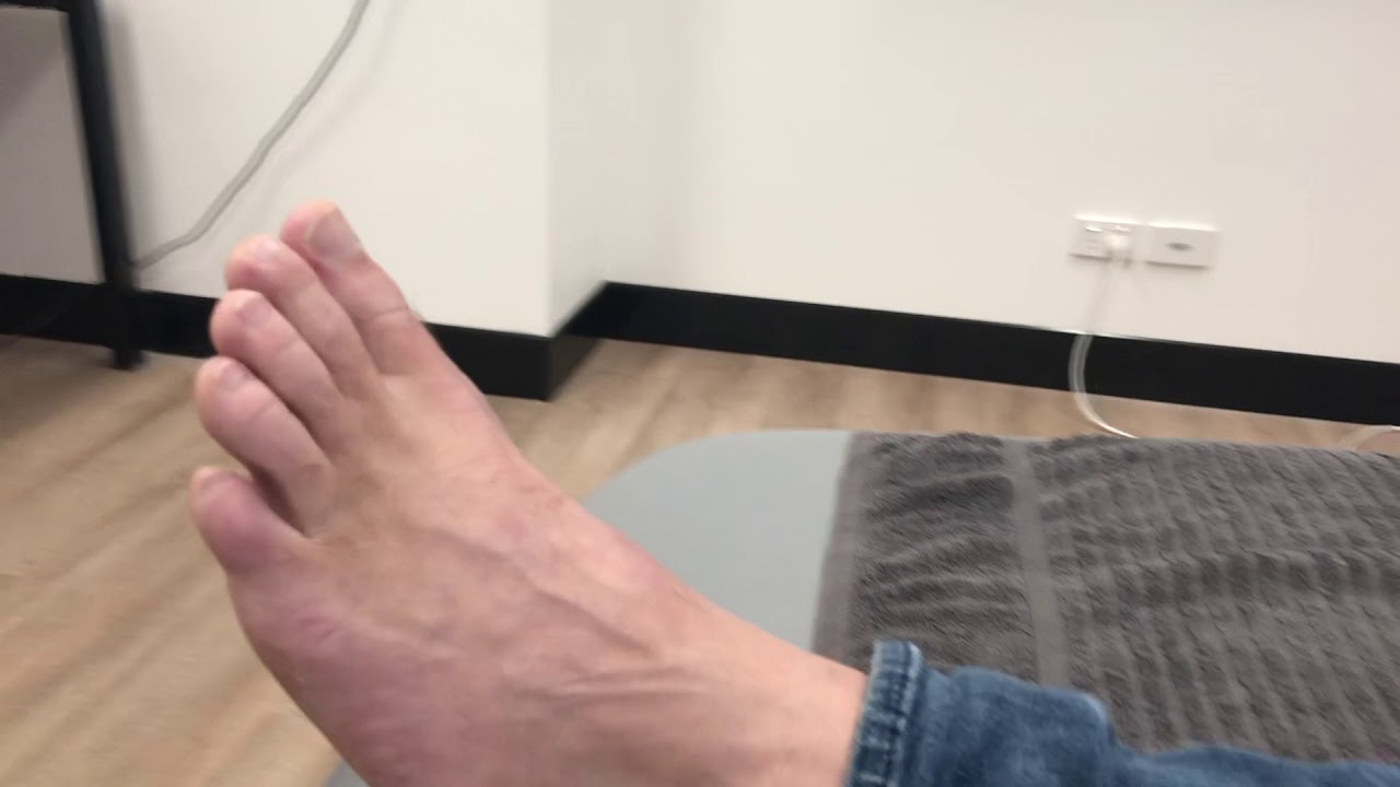 Deep Peroneal Nerve Damage - Post Treatment