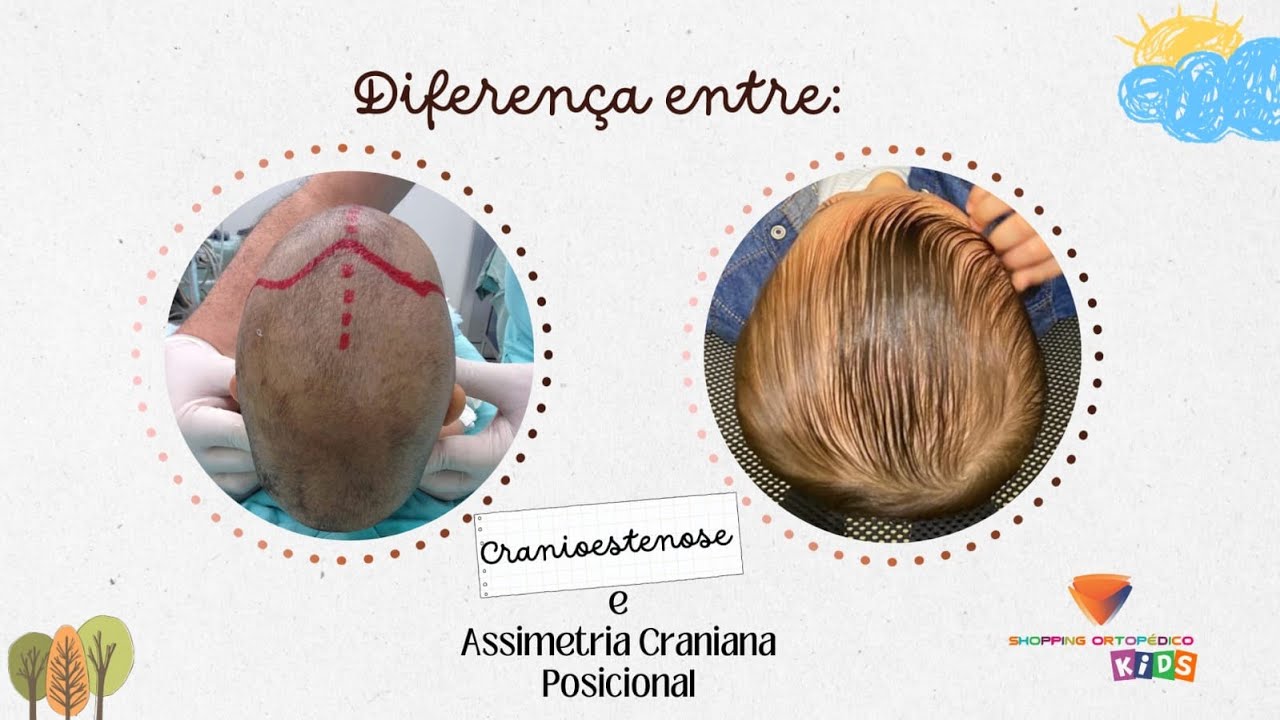Diferença entre : Cranioestenose e Assimetria Craniana Posicional