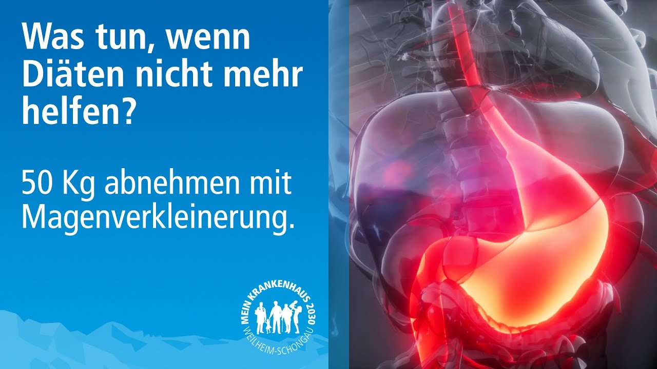 50 Kg Gewichtsreduktion durch Magenverkleinerung | Adipositaschirurgie | Schlauchmagen OP