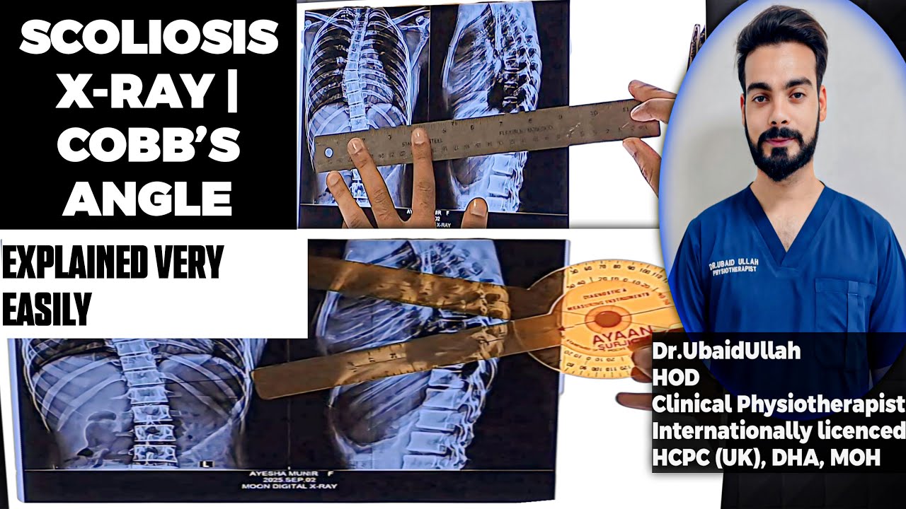 How to Measure Cobb’s Angle on X-Ray | Explained Simply