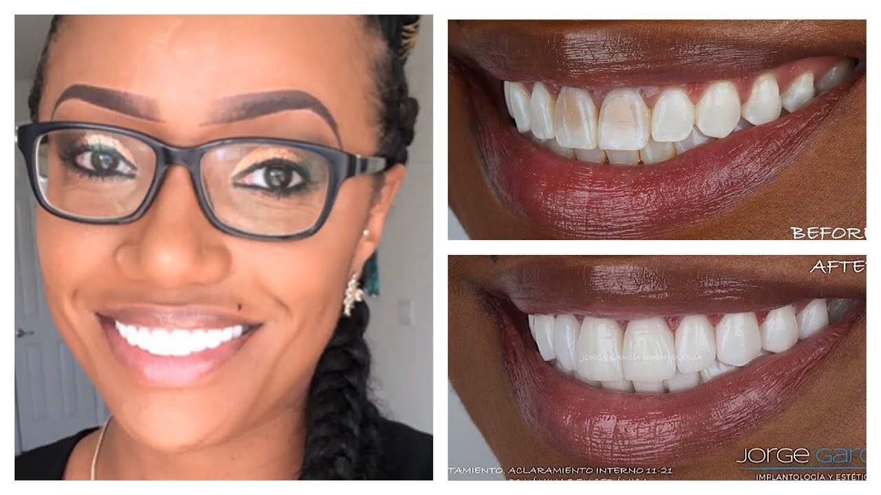 Veneers in Cali | Colombia  Cosmetic Tourism |  Smile Makeover | Dr Jorge Garcia