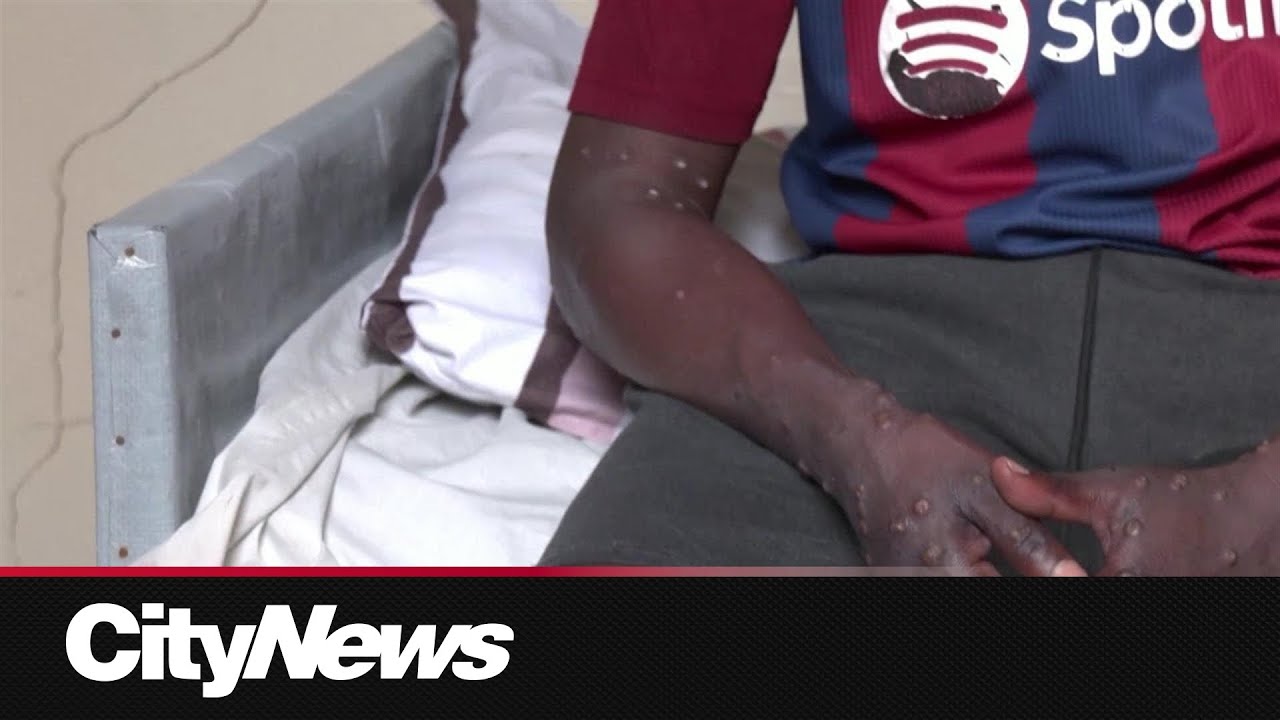 Does mpox pose a risk in Canada?