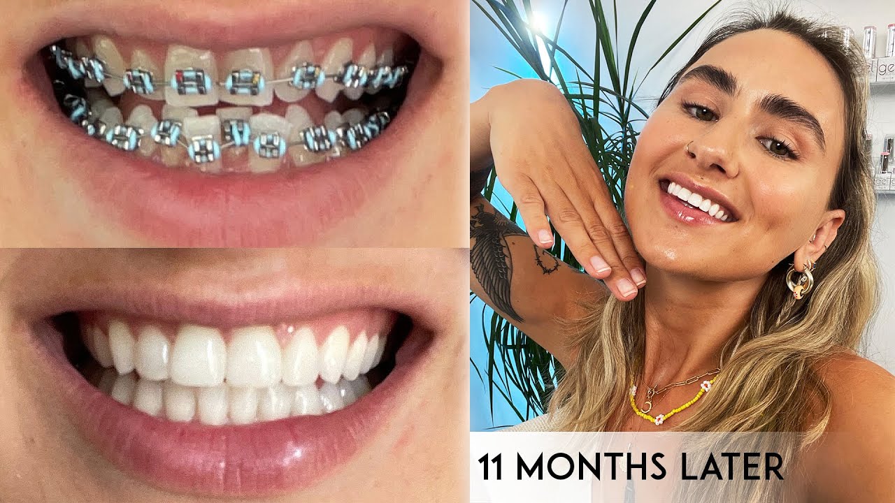 Getting My Braces Off | Before & After Transformation