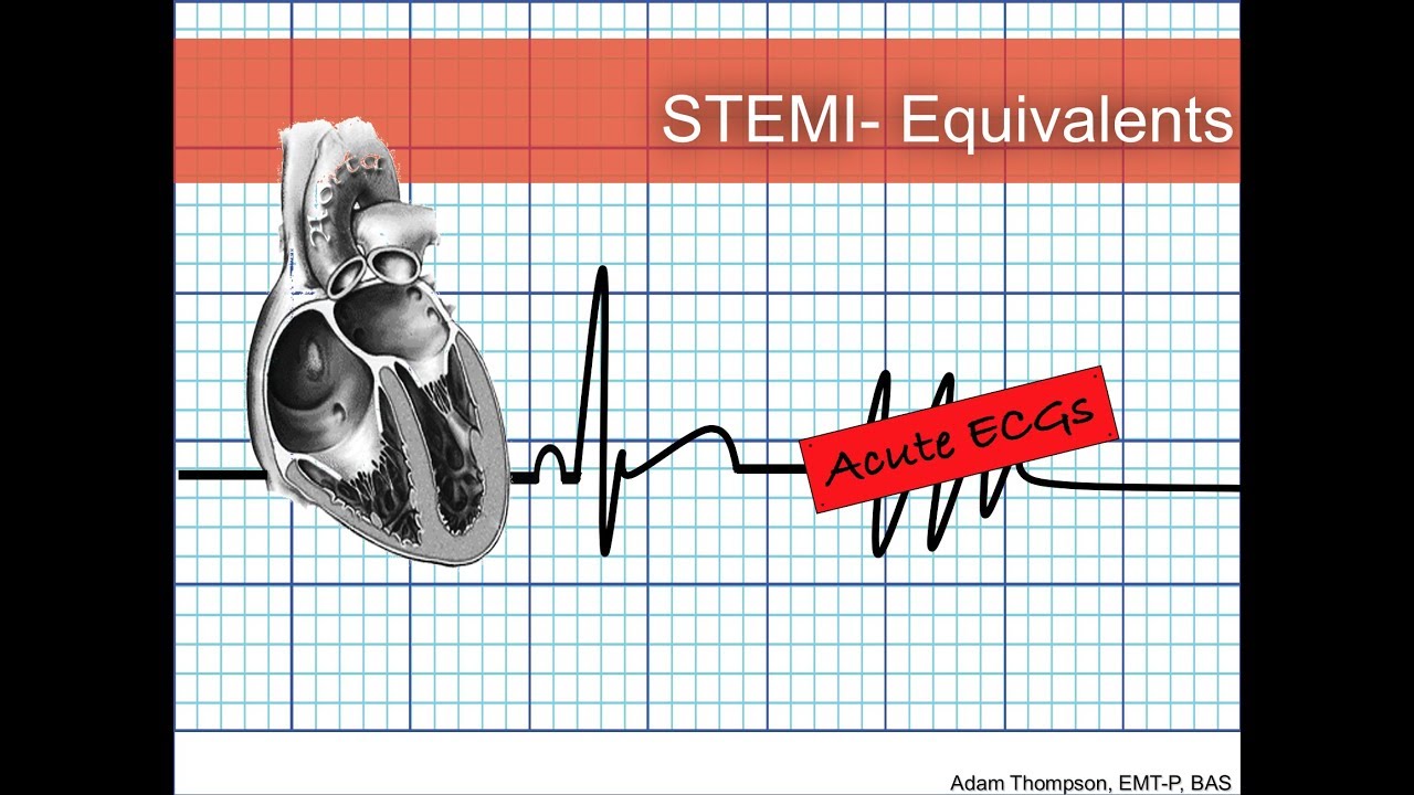 STEMI Equivalents