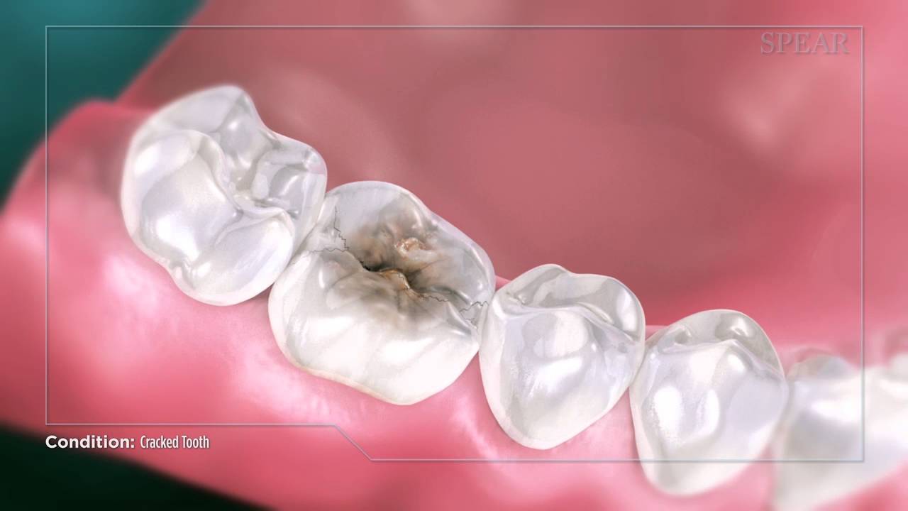 Cracked Tooth