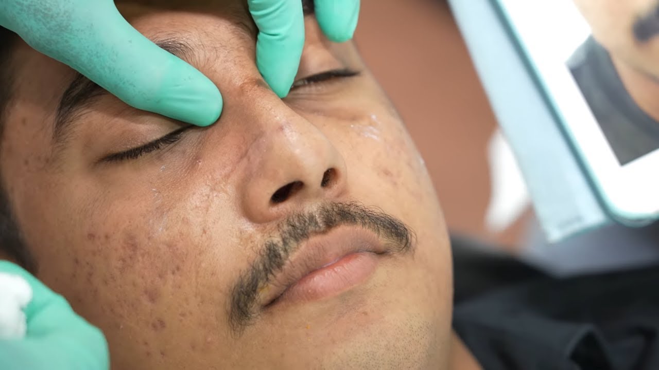 Rhinoplasty Nose Job Post Operative Results + Recovery - Before and After