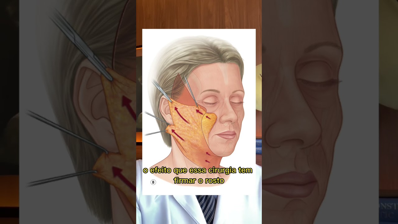 Caso de Lifting Facial Deep Plane em paciente de 50 anos. #cirurgiapl&aacute;stica #liftingfacial