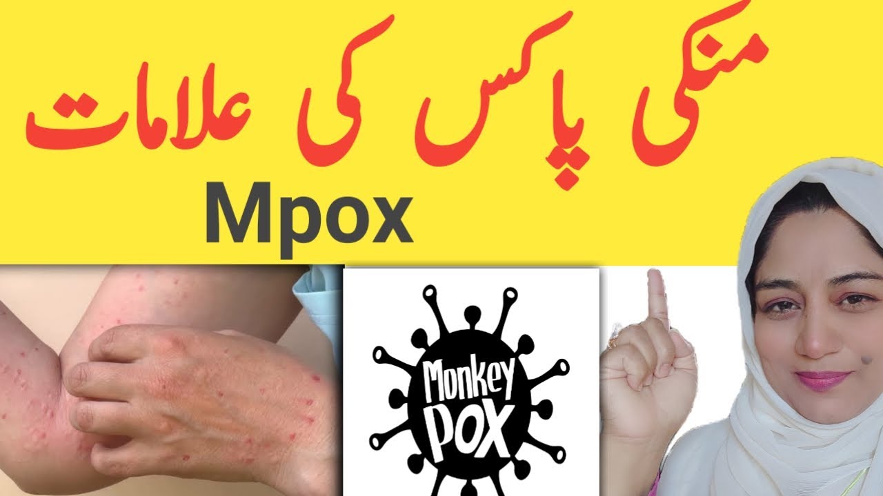 Monkey Pox  Symptoms l How to Boost Immunity l l