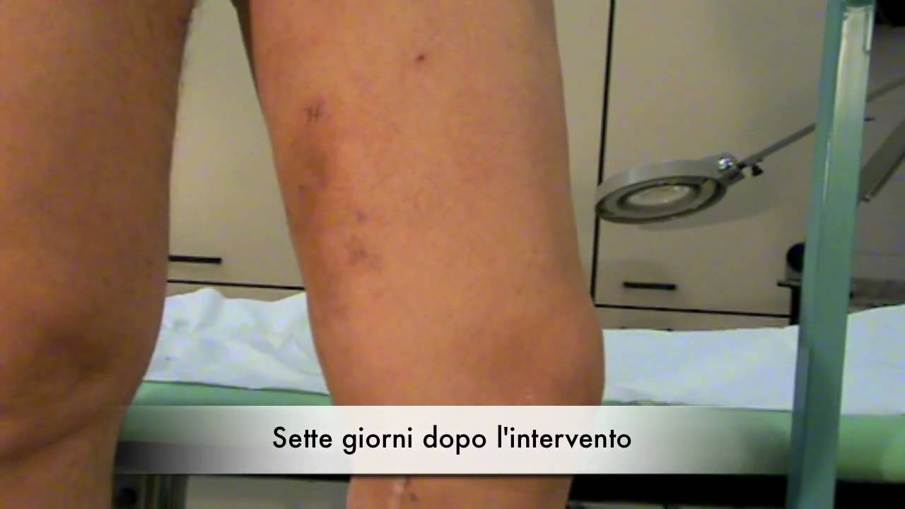 Varici in un uomo , vene varicose stripping laser chiva veneinforma
