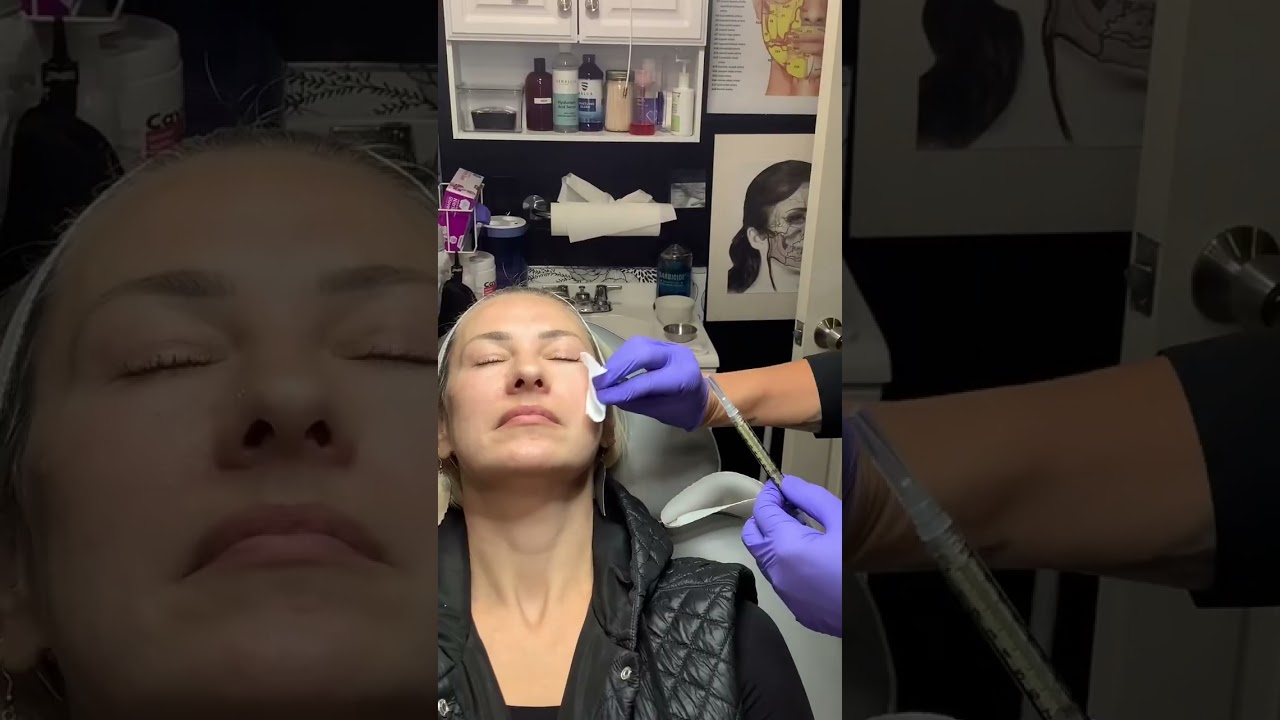 Cellenis DermaGel PRP / for volume loss and skin laxity