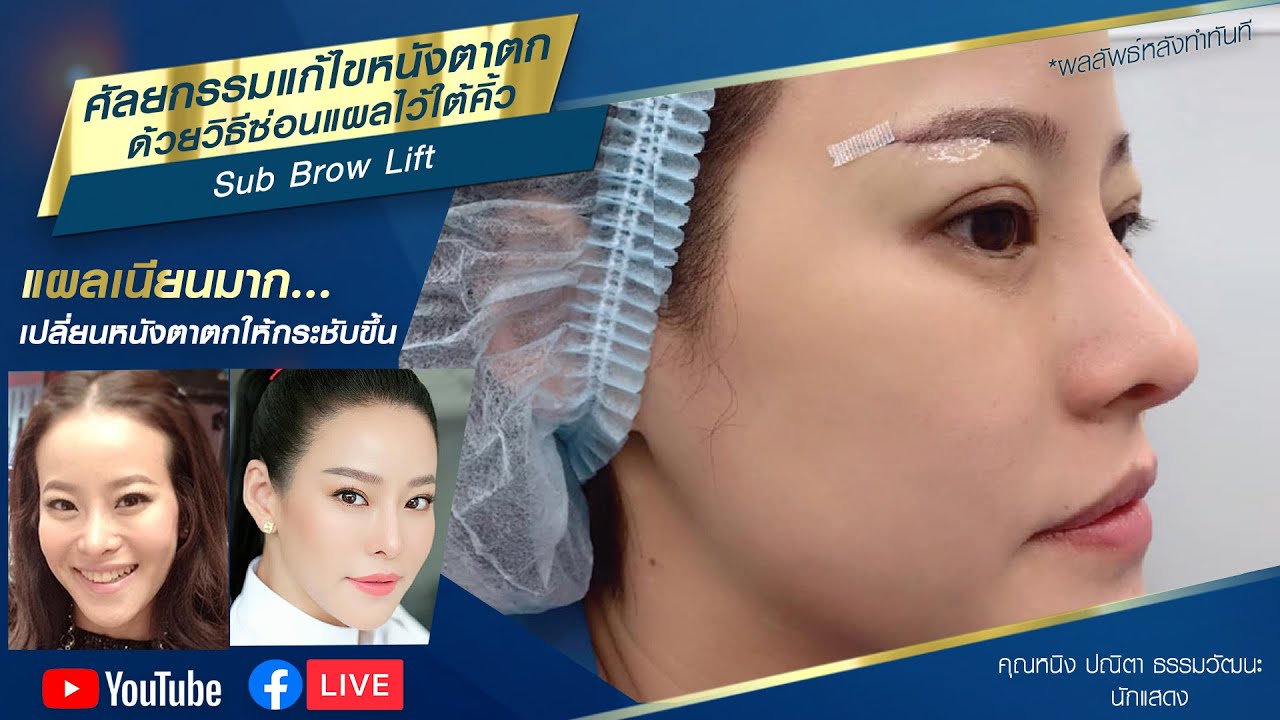 คุณหนิง ปณิตา แก้ไขหนังตาตกด้วยวิธีซ่อนแผลไว้ใต้คิ้ว #SubBrowLift