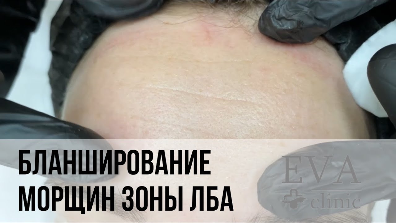 БЛАНШИРОВАНИЕ МОРЩИН ЗОНЫ ЛБА