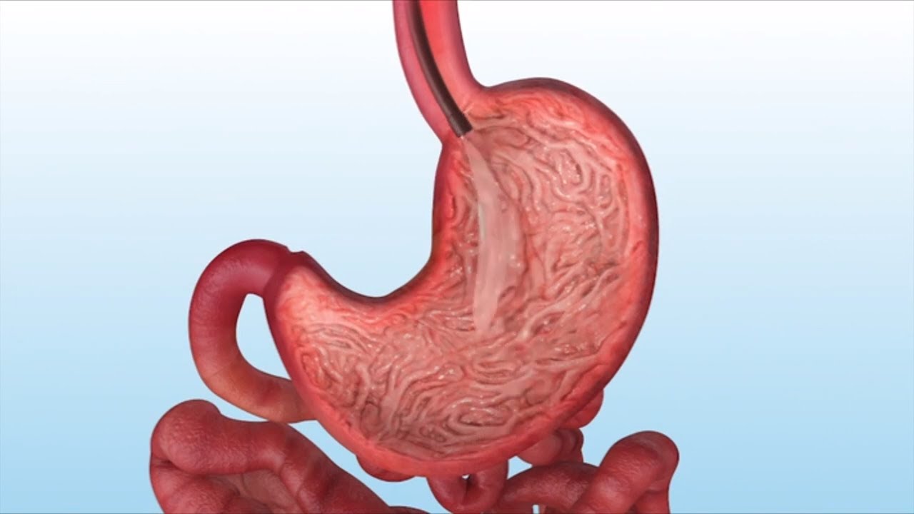 How is the Gastric Balloon Inserted and Removed?