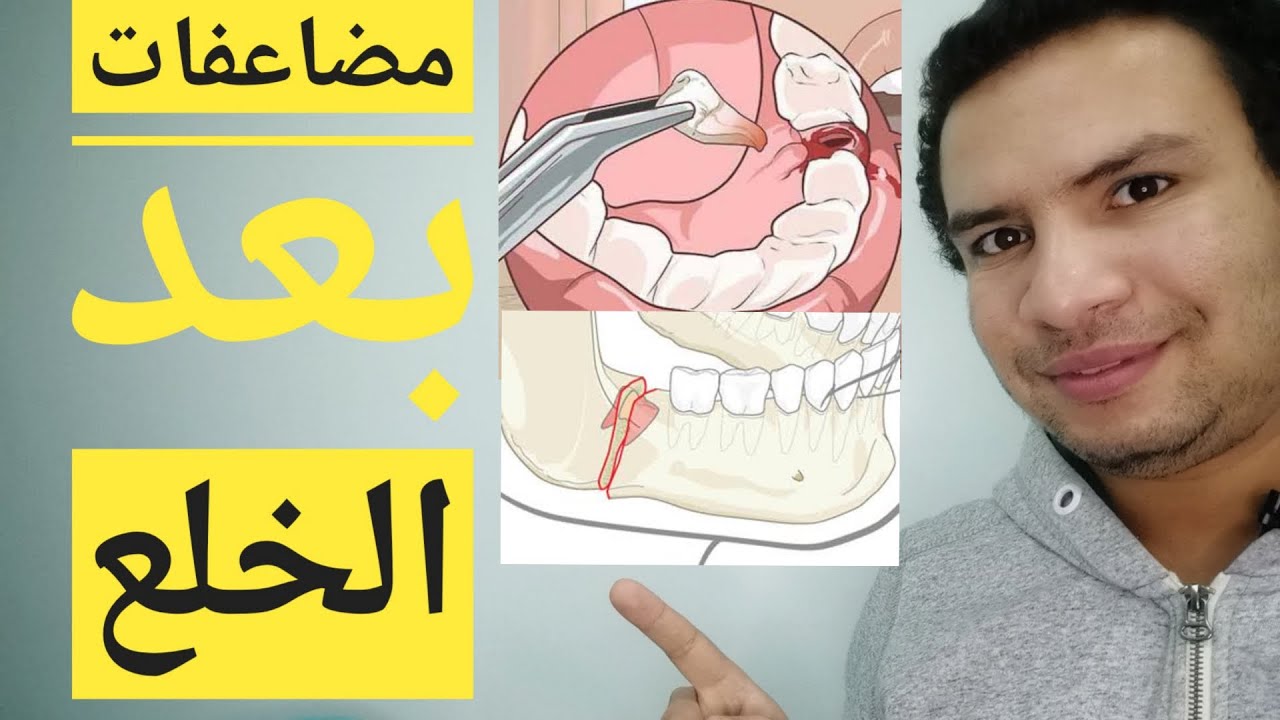 6 مضاعفات بعد خلع الضرس و اسباب الم بعد الخلع