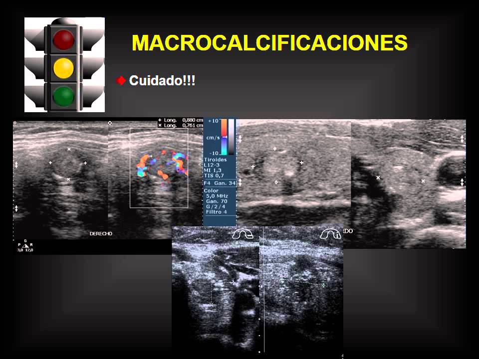 NODULO TIROIDEO