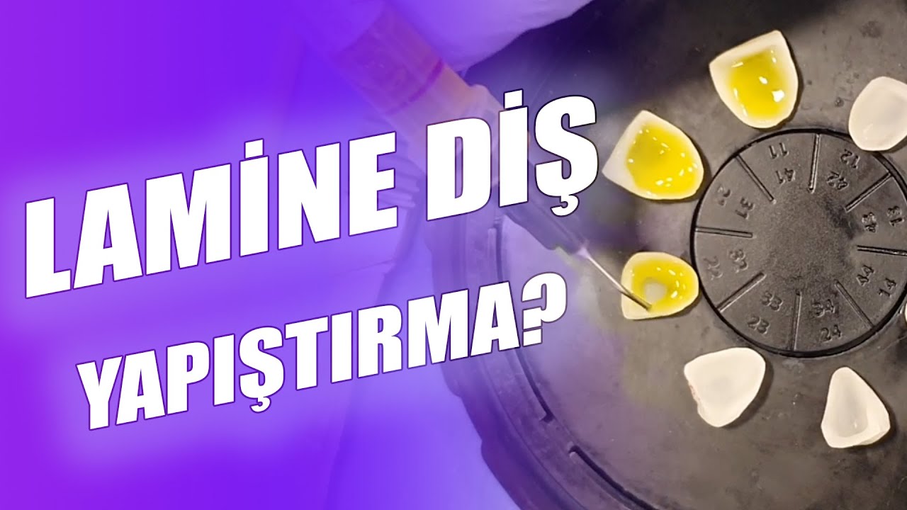 Lamine Simantasyonu Nasıl Yapılır? Lamine Diş Nasıl Yapıştırılır?