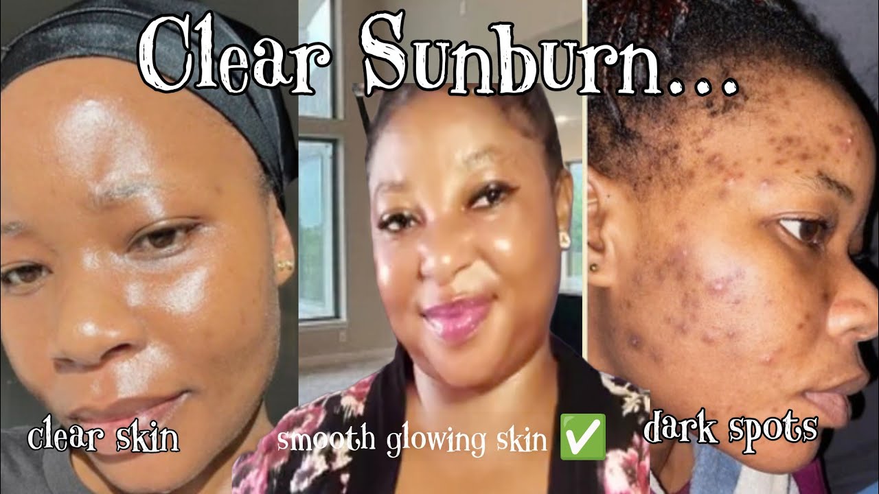 Best brightening face creams for SUNBURN 💯|how to clear sunburn permanently 