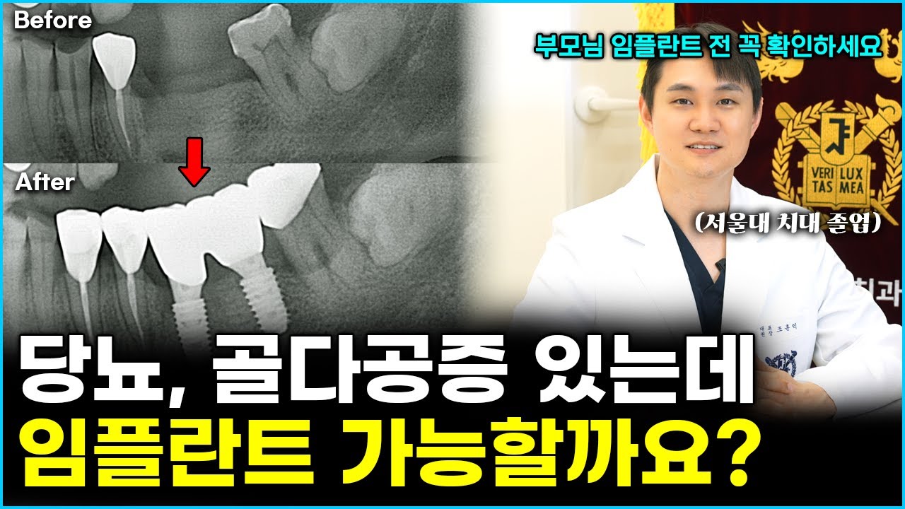 당뇨 골다공증 등 전신질환 있는데 임플란트 가능할까요?
