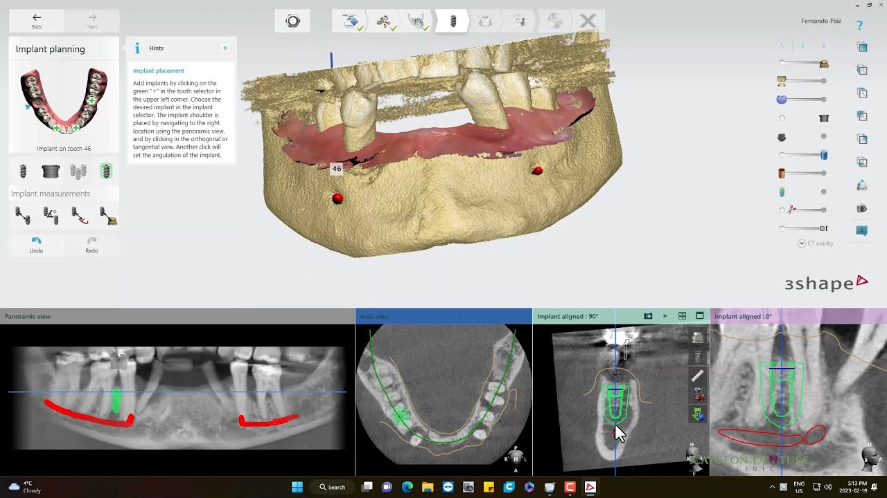 Trying 3Shape Implant Studio