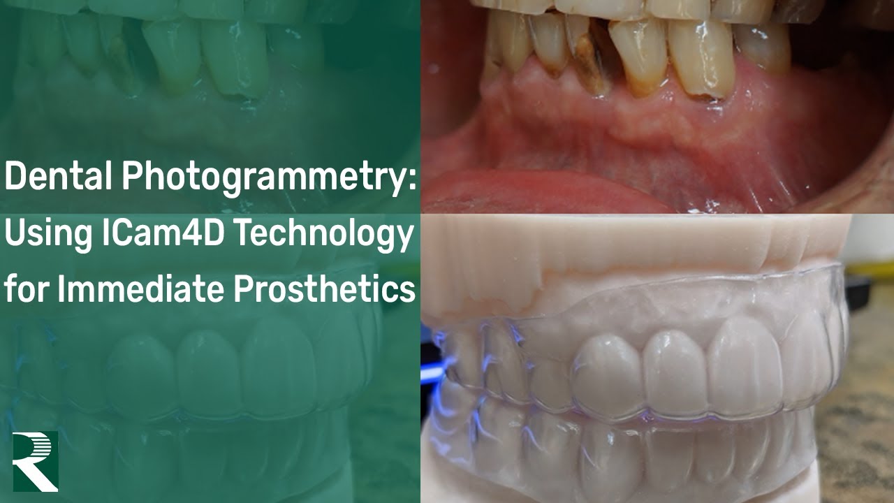 Full Arch Dental Photogrammetry: Using ICam4D Technology for Immediate Prosthetics