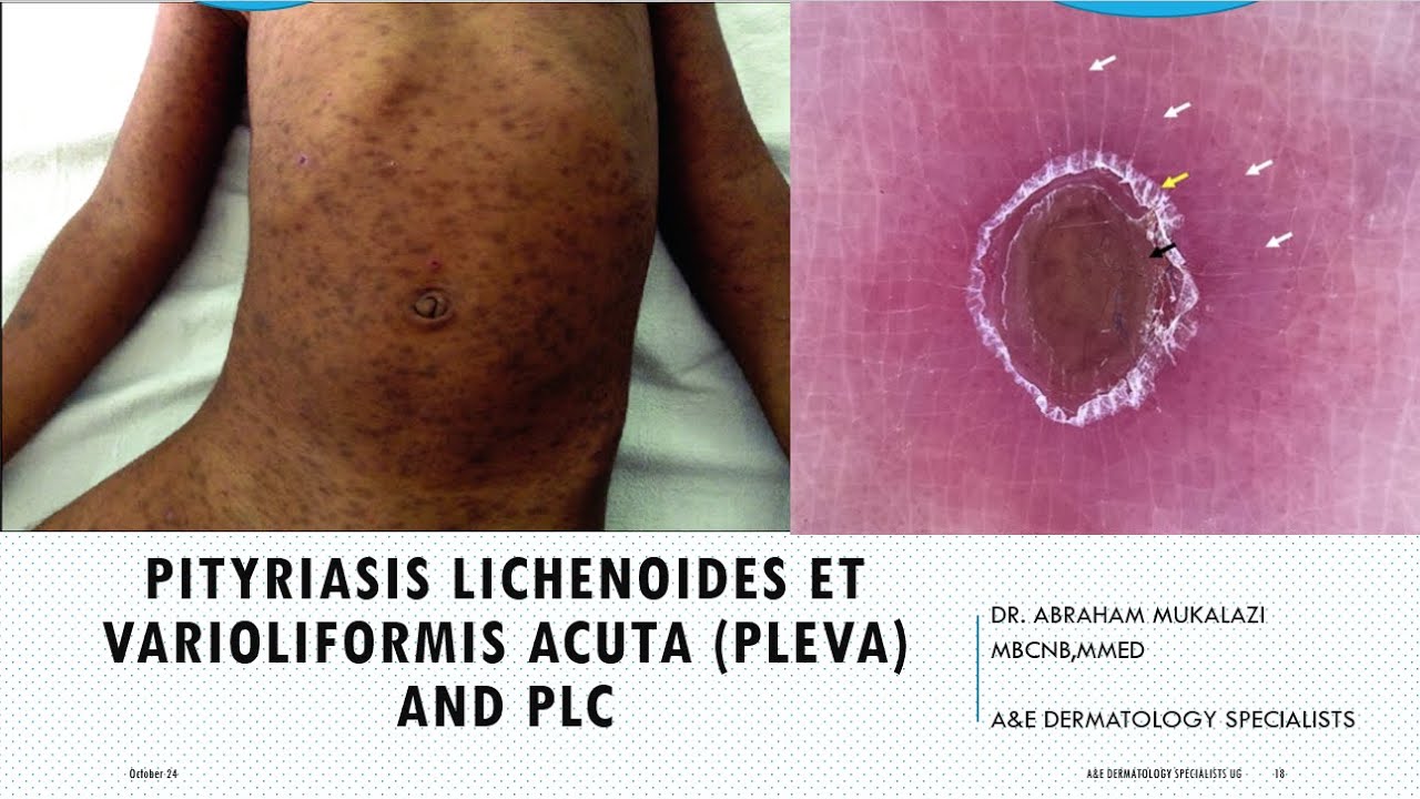 pityriasis lichenoides et varioliformis acuta (PLEVA) and pityriasis lichenoides chronica (PLC)