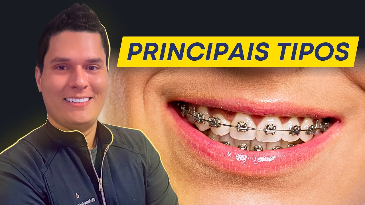 Principais Tipos de Aparelhos Ortodônticos e suas Indicações!