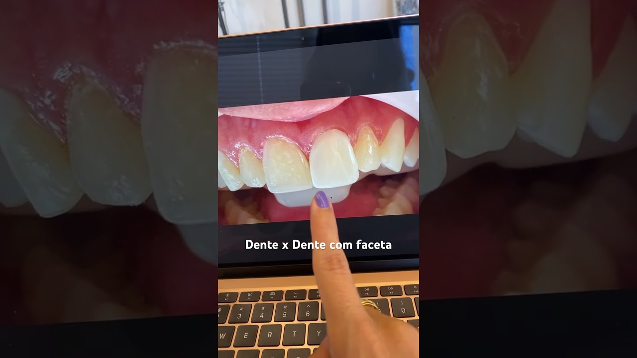 Diferen&ccedil;a entre um dente x dente com a faceta em resina. ☺️
