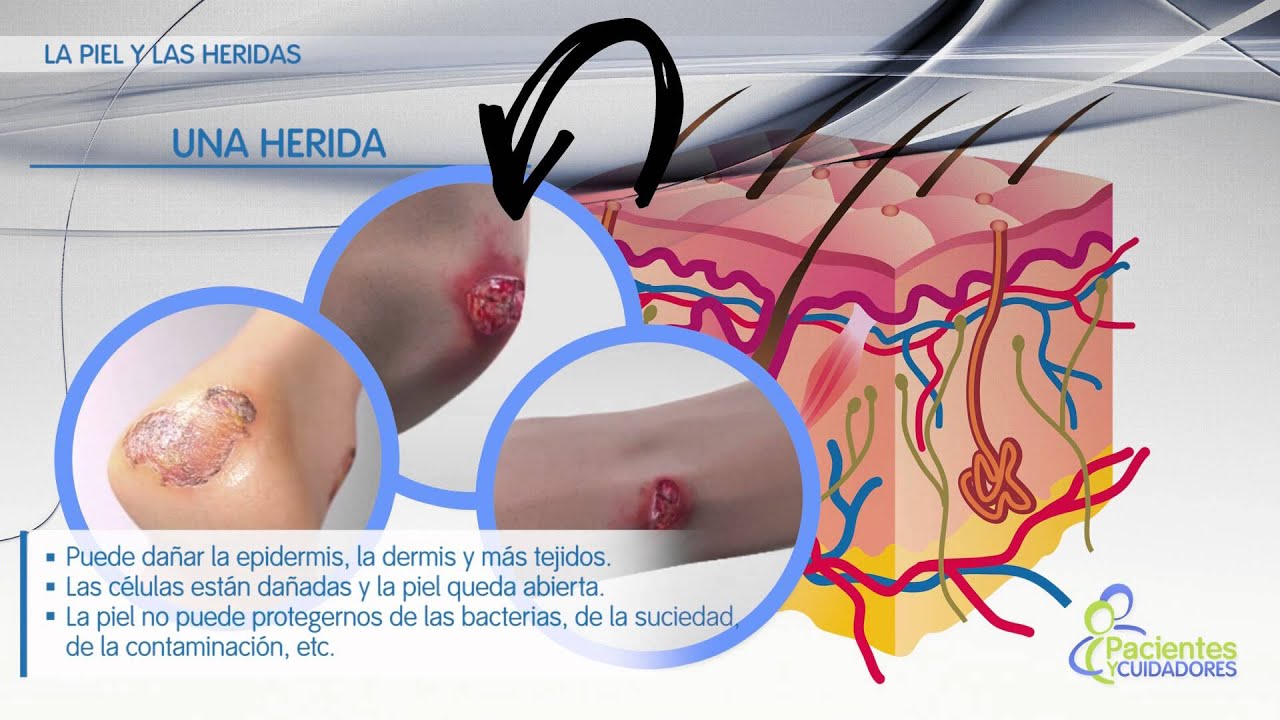 La piel y las heridas, el proceso de cicatrización.