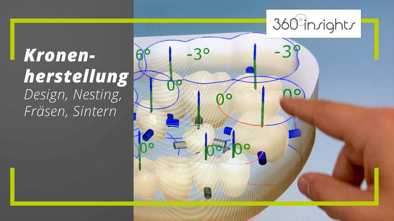 Kronenherstellung (Design, Nesting, Fräsen & Sintern | 360°zahn insights