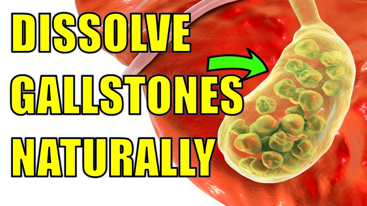 How to Dissolve Gallstones Naturally | How To Pass Dissolve Gallstones Fast Naturally