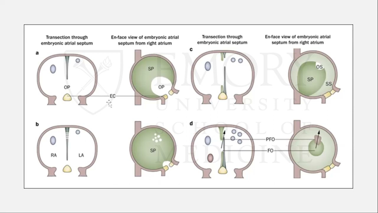 Atrial Septal Defects