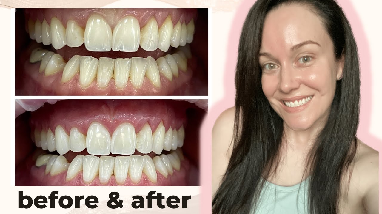 I had laser teeth whitening (let’s talk about the pain!)
