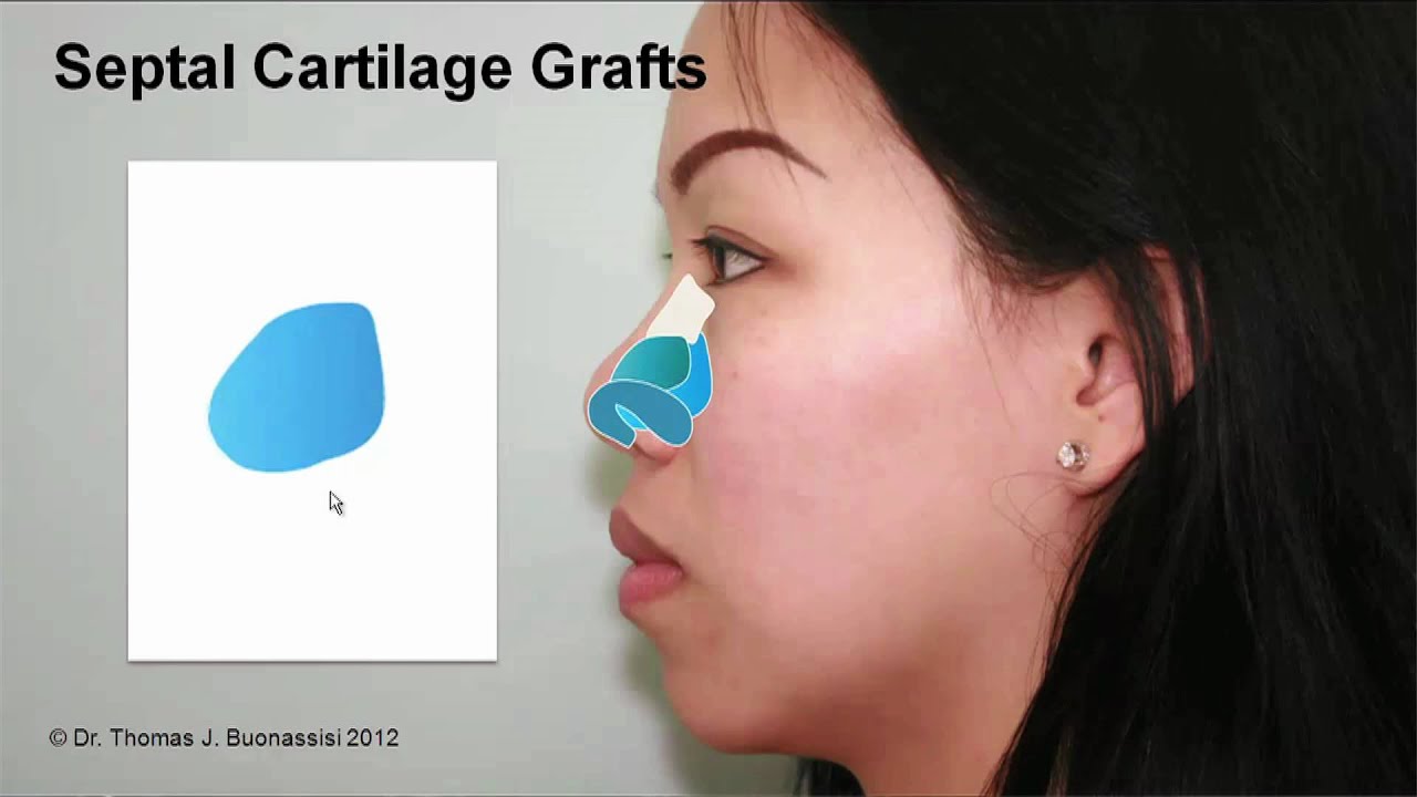 Septal Cartilage Grafts Case Study Part 1 | Asian Rhinoplasty with Dr. Buonassisi in Vancouver BC