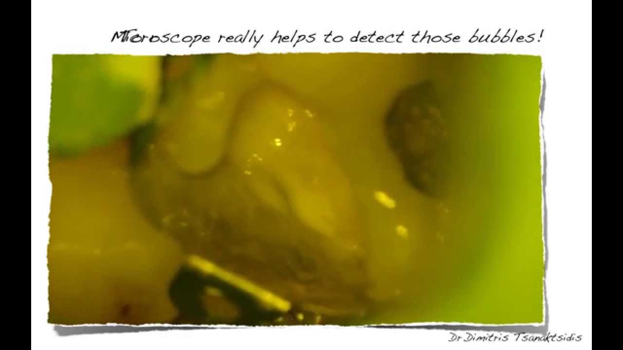 Tips & Tricks in Bonding - Microscopic Dentistry