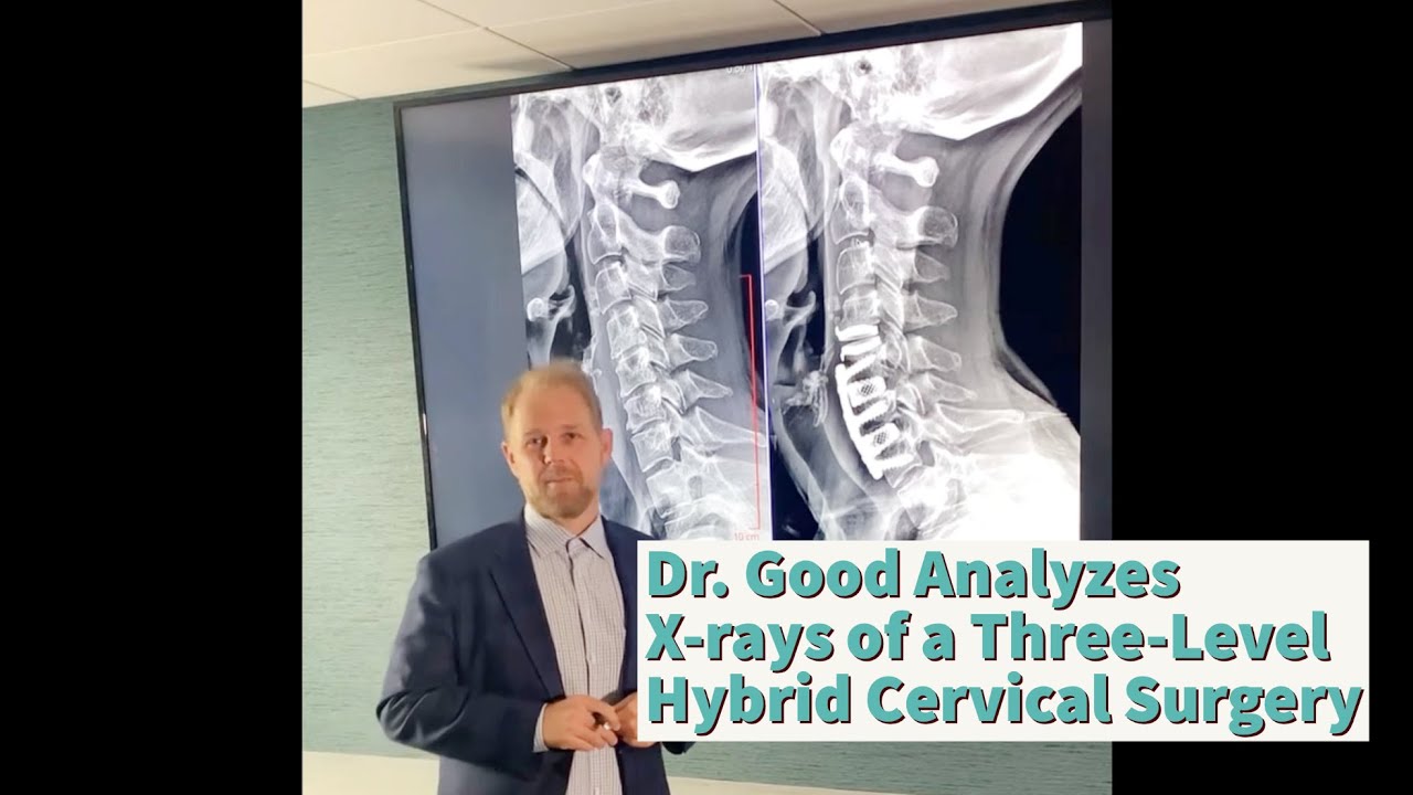 Dr. Good Analyzes X-rays of a Three-Level Hybrid Cervical Surgery